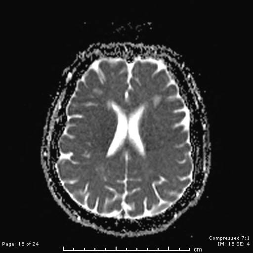 File:Cerebellar strokes due to intracranial giant cell arteritis (Radiopaedia 68799-81713 Axial ADC 15).jpg