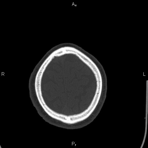 Cerebellopontine angle arachnoid cyst (Radiopaedia 85149-100704 Axial bone window 47).jpg