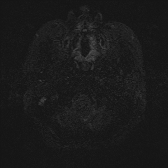 Cerebellopontine angle meningioma (Radiopaedia 53561-59591 Axial 3D volume T2 1).jpg