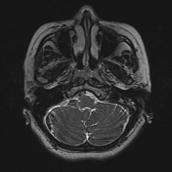 Cerebellopontine angle meningioma (Radiopaedia 53561-59591 Axial 3D volume T2 34).jpg
