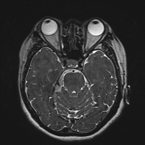 Cerebellopontine angle meningioma (Radiopaedia 53561-59591 Axial 3D volume T2 82).jpg