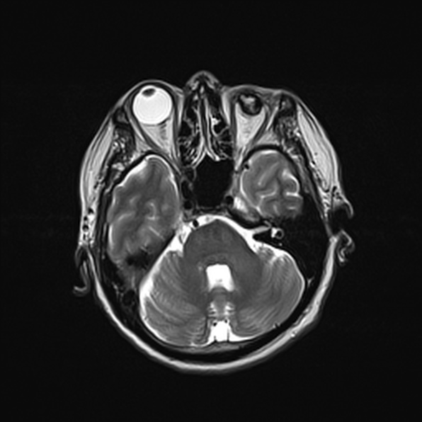 Cerebral abscess (Radiopaedia 26111-26247 Axial T2 21).jpg
