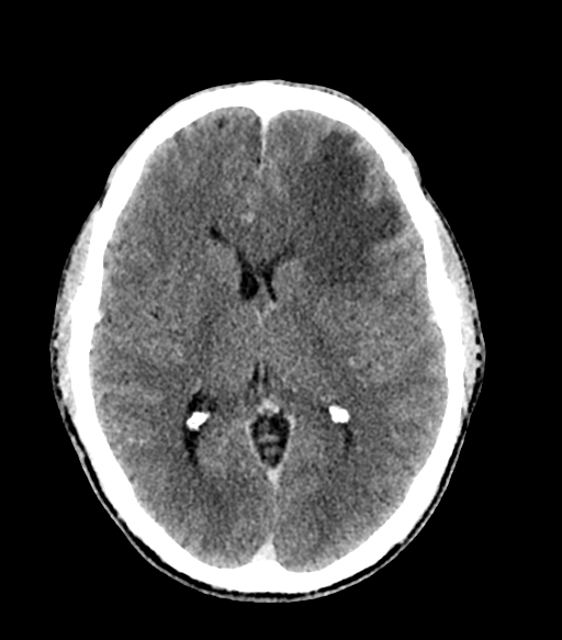 Cerebral abscess (Radiopaedia 57774-64741 Axial C+ delayed 37).png