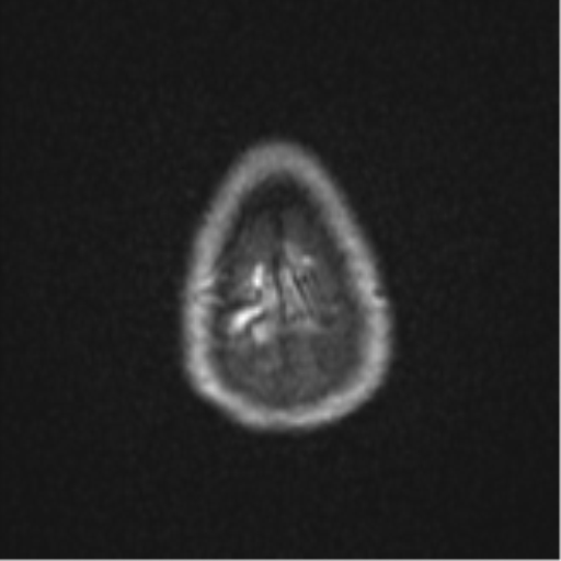 Cerebral abscess (Radiopaedia 60342-68009 Axial DWI 35).png