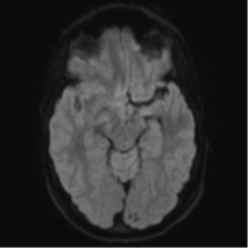 File:Cerebral abscess (Radiopaedia 60342-68009 Axial DWI 50).png