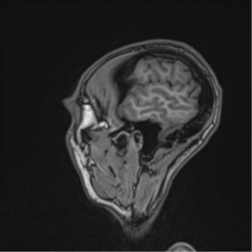Cerebral abscess (Radiopaedia 60342-68009 Sagittal T1 11).png