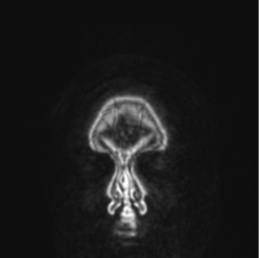 File:Cerebral abscess from pulmonary arteriovenous malformation (Radiopaedia 86275-102291 L 89).png