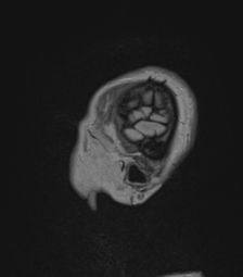 Cerebral abscess from pulmonary arteriovenous malformation (Radiopaedia 86275-102291 Sagittal FLAIR 6).png
