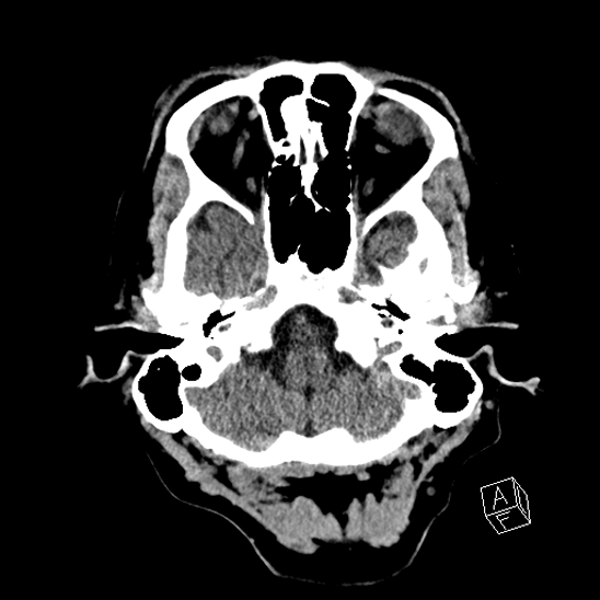 Cerebral abscess with ventriculitis (Radiopaedia 78965-91876 Axial non-contrast 11).jpg