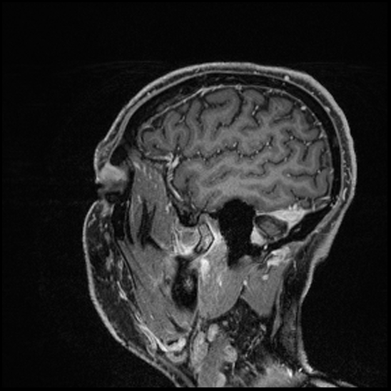 Cerebral abscess with ventriculitis (Radiopaedia 78965-91878 Sagittal T1 C+ 147).jpg