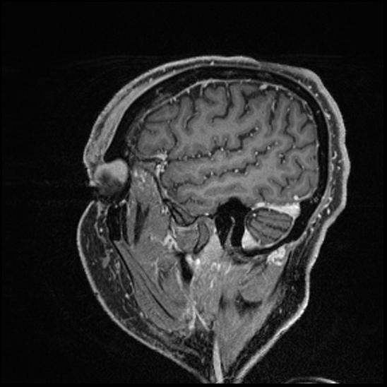 Cerebral abscess with ventriculitis (Radiopaedia 78965-91878 Sagittal T1 C+ 39).jpg
