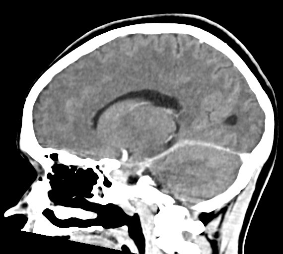 File:Cerebral abscesses (Radiopaedia 70458-80568 Sagittal Contrast 34).jpg