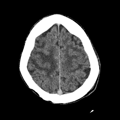 File:Cerebral amyloid angiopathy-related inflammation (Radiopaedia 74836-85848 Axial non-contrast 48).jpg