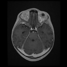 File:Cerebral and spinal tuberculosis (Radiopaedia 90489-107837 Axial T1 C+ 76).jpg