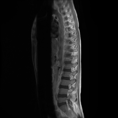 File:Cerebral and spinal tuberculosis (Radiopaedia 90489-107912 Sagittal T1 C+ 3).jpg