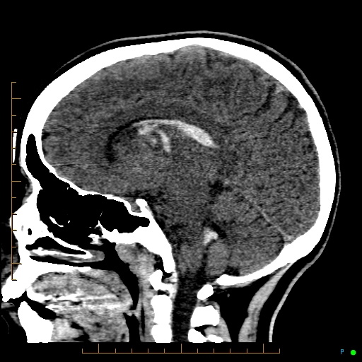 File:Cerebral arteriovenous malformation (AVM) (Radiopaedia 78162-90706 A 36).jpg