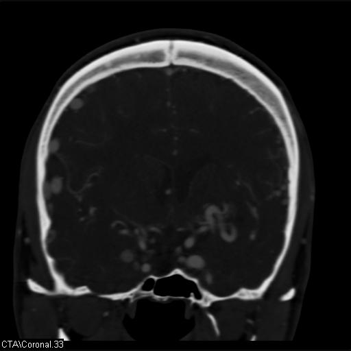 Cerebral arteriovenous malformation (Radiopaedia 28518-28759 C 33).jpg