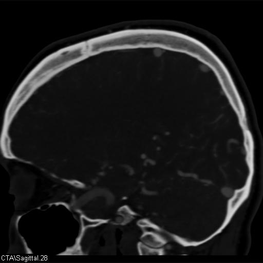 Cerebral arteriovenous malformation (Radiopaedia 28518-28759 D 25).jpg