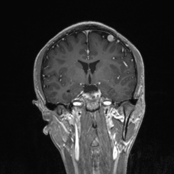 Cerebral arteriovenous malformation (Radiopaedia 30198-30813 F 29).jpg