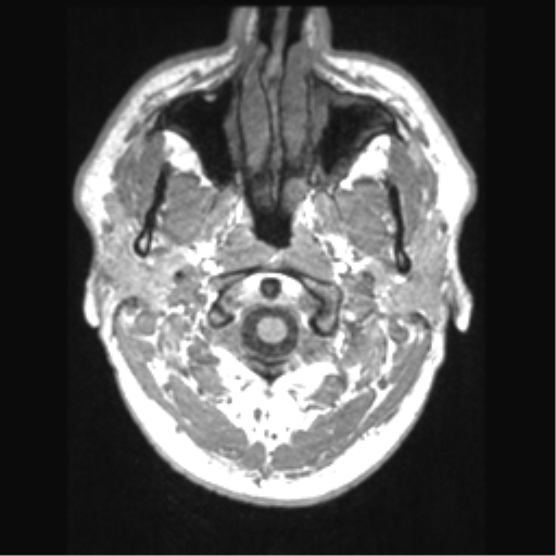 Cerebral arteriovenous malformation (Radiopaedia 39259-41506 Axial T1 4).png