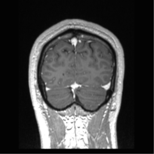 Cerebral arteriovenous malformation (Radiopaedia 39259-41506 Coronal T1 C+ 17).png