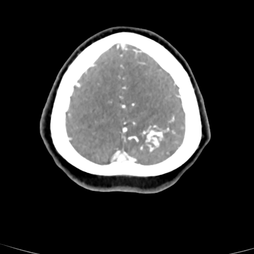 Cerebral arteriovenous malformation (Radiopaedia 73830-84645 B 15).jpg