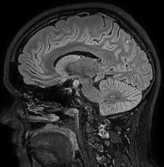 Cerebral arteriovenous malformation (Radiopaedia 74411-85654 Sagittal FLAIR 51).jpg