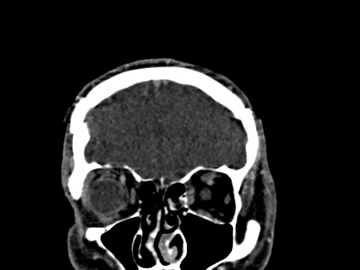Cerebral arteriovenous malformation (Radiopaedia 78188-90746 Coronal C+ delayed 13).jpg