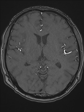 Cerebral arteriovenous malformation (Radiopaedia 84015-99245 Axial TOF 130).jpg