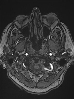 File:Cerebral arteriovenous malformation (Radiopaedia 84015-99245 Axial TOF 41).jpg