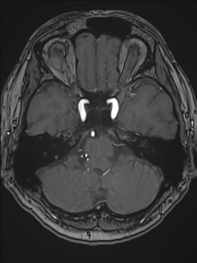 File:Cerebral arteriovenous malformation (Radiopaedia 84015-99245 Axial TOF 78).jpg