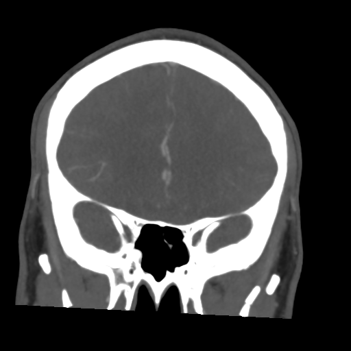 File:Cerebral arteriovenous malformation (Spetzler-Martin grade 2) (Radiopaedia 41262-44076 F 21).png