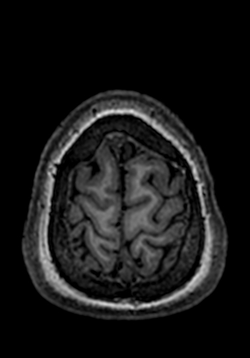 Cerebral arteriovenous malformation at posterior body of corpus callosum (Radiopaedia 74111-84925 Axial T1 14).jpg