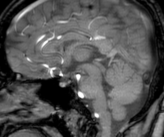 Cerebral arteriovenous malformation at posterior body of corpus callosum (Radiopaedia 74111-84925 J 194).jpg