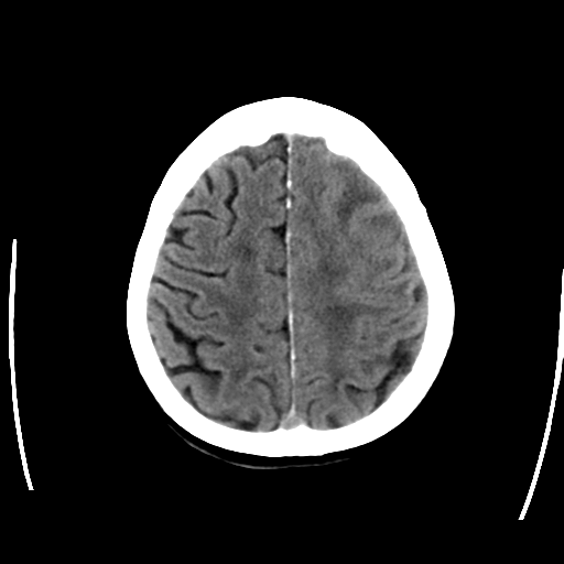 File:Cerebral arteriovenous malformation with lobar hemorrhage (Radiopaedia 44725-48512 Axial non-contrast 27).png