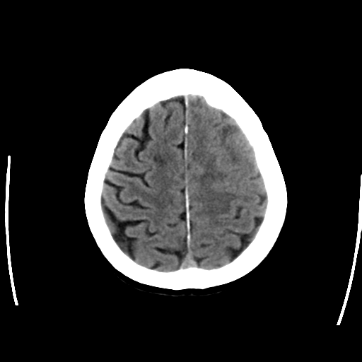 File:Cerebral arteriovenous malformation with lobar hemorrhage (Radiopaedia 44725-48512 Axial non-contrast 28).png