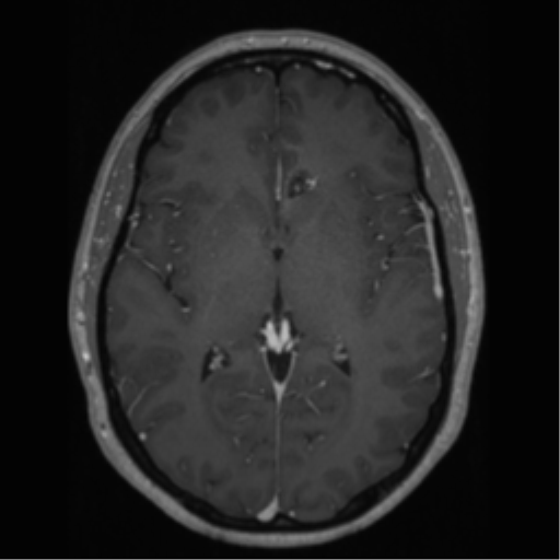 File:Cerebral cavernoma and development venous anomaly (Radiopaedia 37603-39482 Axial T1 C+ 39).png