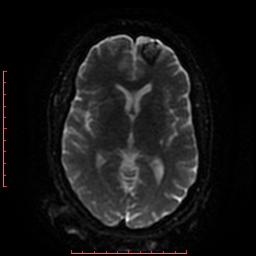 File:Cerebral cavernous malformation (Radiopaedia 26177-26306 Axial DWI 31).jpg