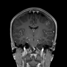Cerebral cavernous venous malformation (Radiopaedia 70008-80021 Coronal T1 C+ 31).jpg