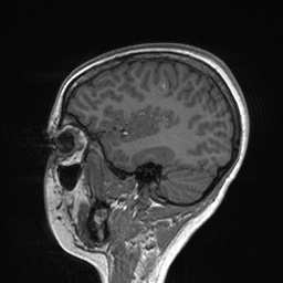 File:Cerebral cavernous venous malformation (Radiopaedia 70008-80021 Sagittal T1 19).jpg