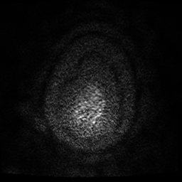 File:Cerebral cavernous venous malformation (Zabramski type II) (Radiopaedia 85511-101198 Axial DWI 66).jpg