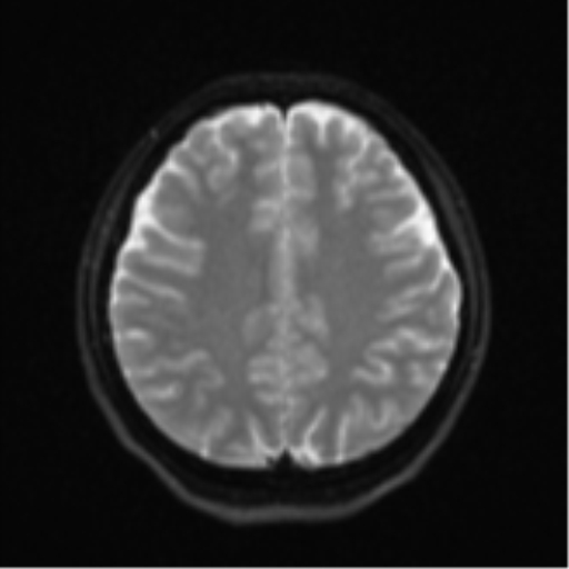Cerebral cavernous venous malformations (Radiopaedia 48117-52946 Axial DWI 19).png