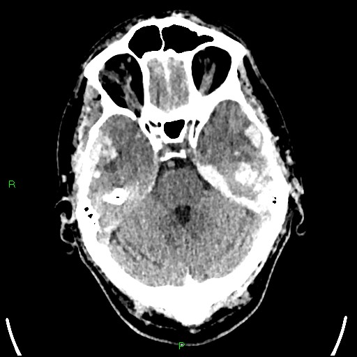 File:Cerebral contusions (Radiopaedia 33868-35039 Axial non-contrast 61).jpg