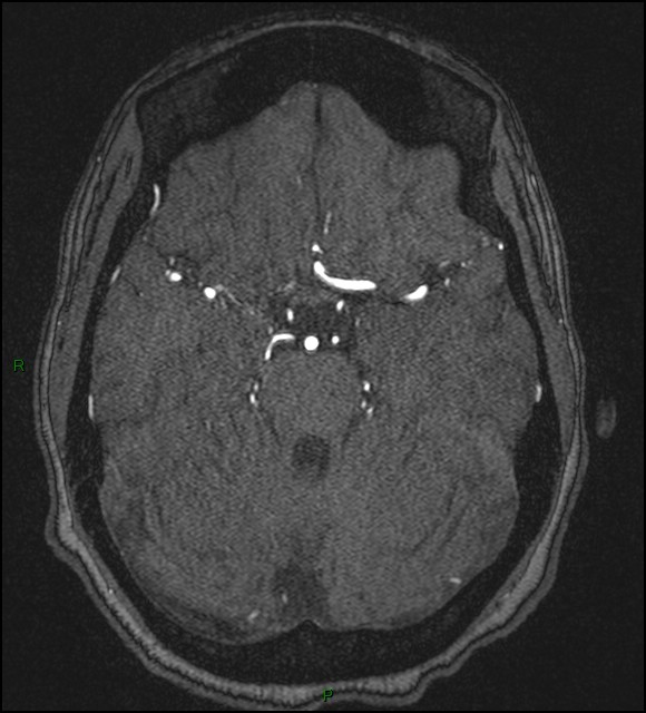 Cerebral fat embolism (Radiopaedia 35022-36525 Axial TOF 70).jpg