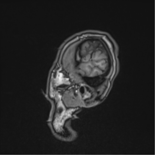 Cerebral fat embolism (Radiopaedia 57697-64639 Sagittal T1 43).png