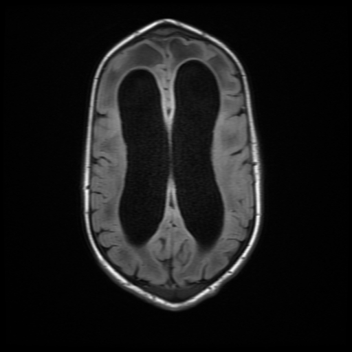 File:Cerebral manifestations of mucopolysaccharidosis type I (Radiopaedia 59171-66487 C 14).jpg