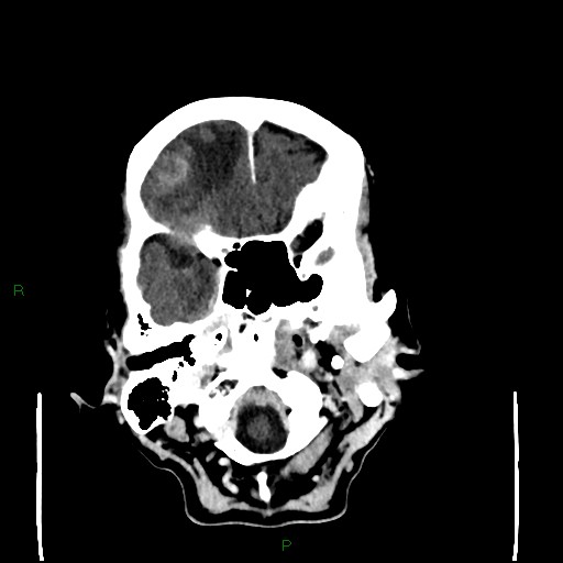 File:Cerebral metastases - breast primary (Radiopaedia 77653-89857 Axial C+ delayed 22).jpg