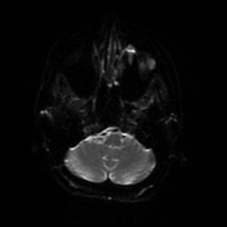 Cerebral metastases - melanoma (Radiopaedia 80972-94522 Axial DWI 71).jpg