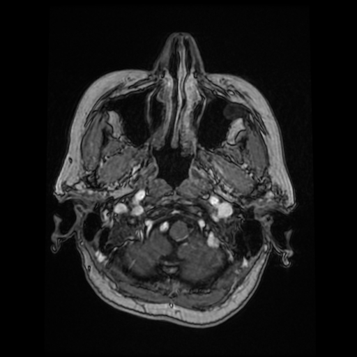 Cerebral metastases - melanoma (Radiopaedia 80972-94522 Axial T1 C+ 26).jpg