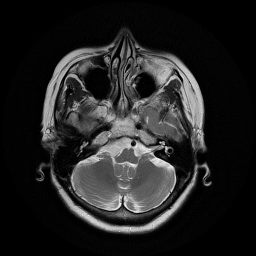 File:Cerebral metastases - melanoma (Radiopaedia 80972-94522 Axial T2 8).jpg